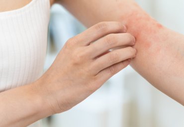 Desarrollarán tratamiento contra la dermatitis atópica